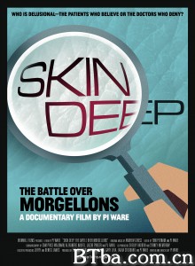 Skin Deep: The Battle Over Morgellons‎-720p|1080p高清bt种子下载